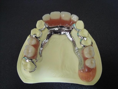 牙齿缺失后的修复方法-义齿-【博瑞特义齿】★义齿